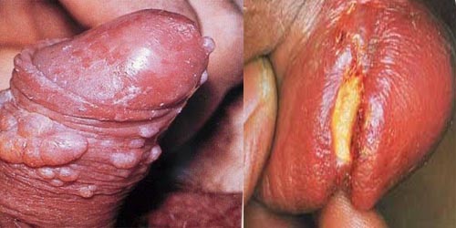 Jual Obat Sipilis De Nature Di Sekadau