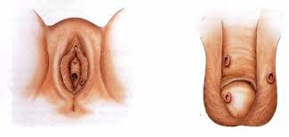 Jual Obat Sipilis De Nature Di Yalimo