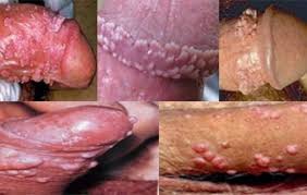 Jual Obat Sipilis De Nature Di Pati