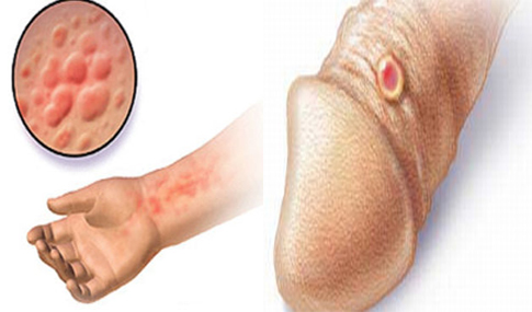 Jual Obat Sipilis De Nature Di Tana Toraja