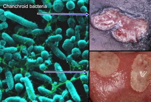 Jual Obat Sipilis De Nature Di Raja Ampat